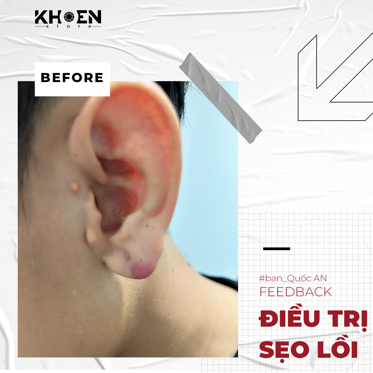 Trước 2 tuần điều trị sẹo lồi của bạn Quốc An