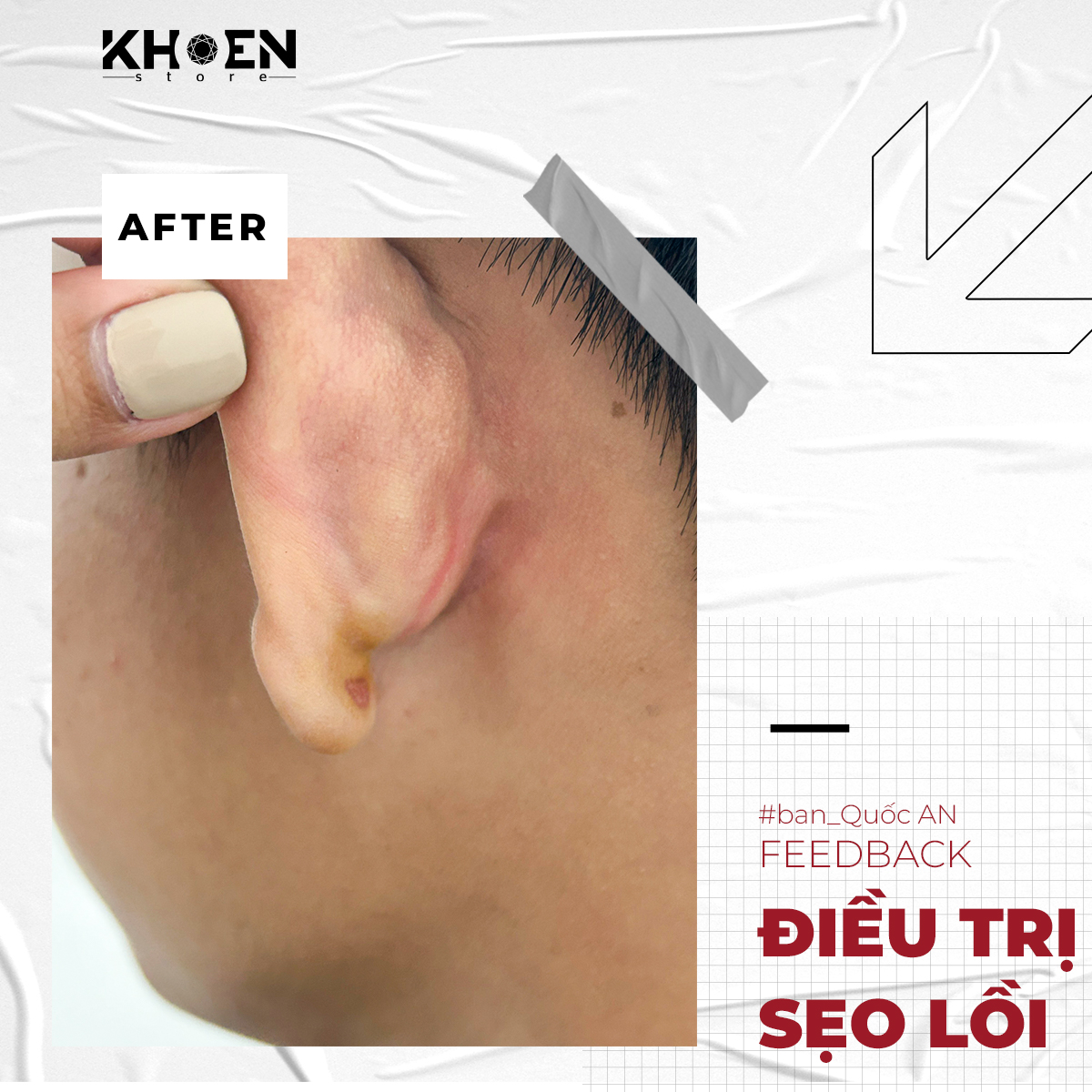 Sau 2 tuần điều trị sẹo lồi của bạn Quốc An