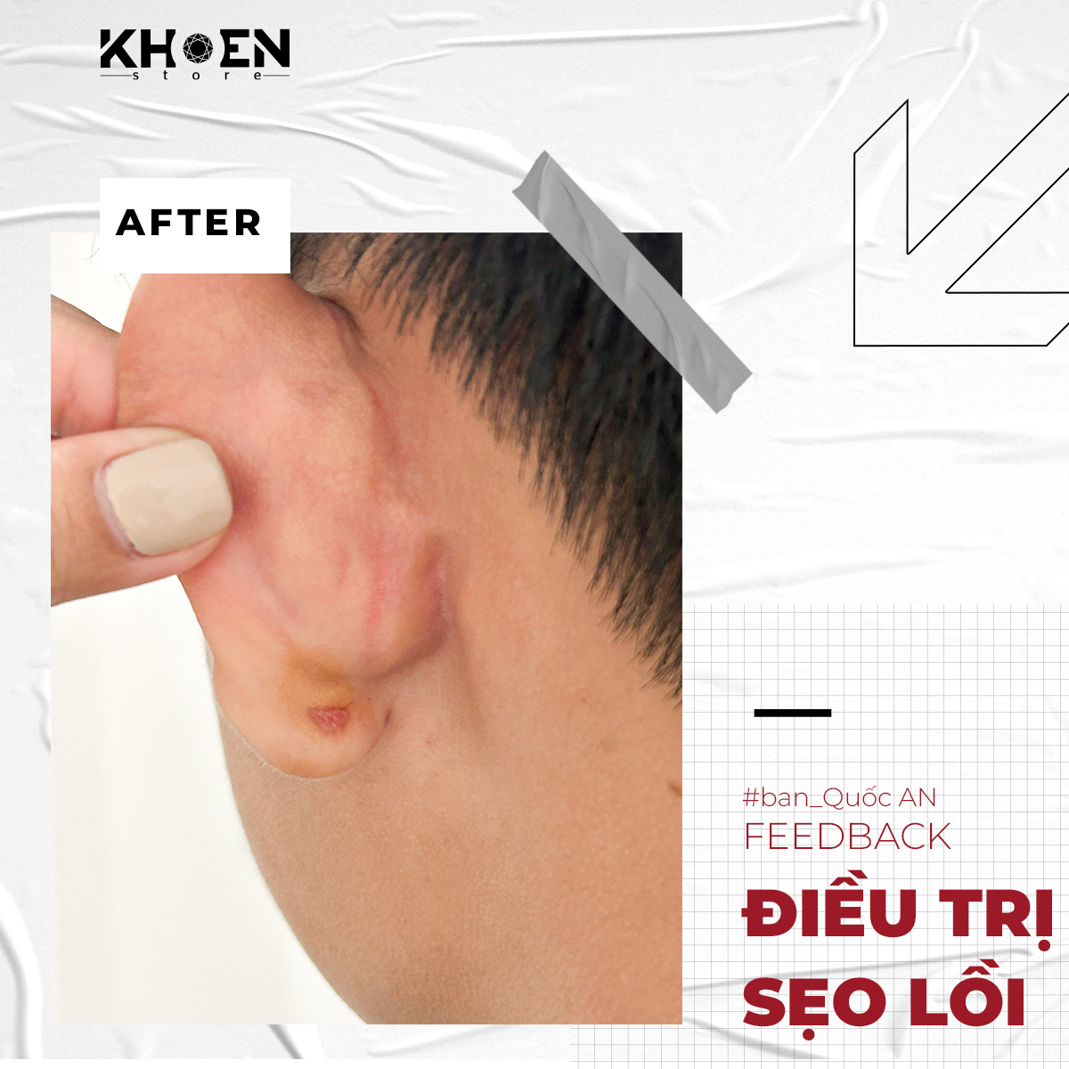 Sau 2 tuần điều trị sẹo lồi của bạn Quốc An