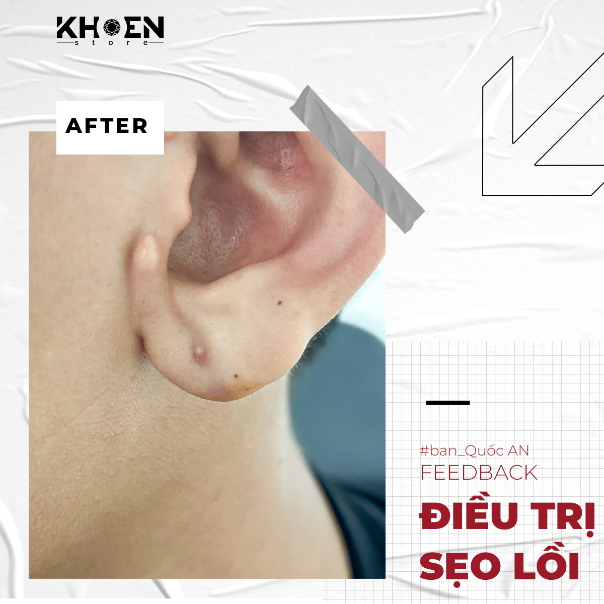 Trước 2 tuần điều trị sẹo lồi của bạn Quốc An