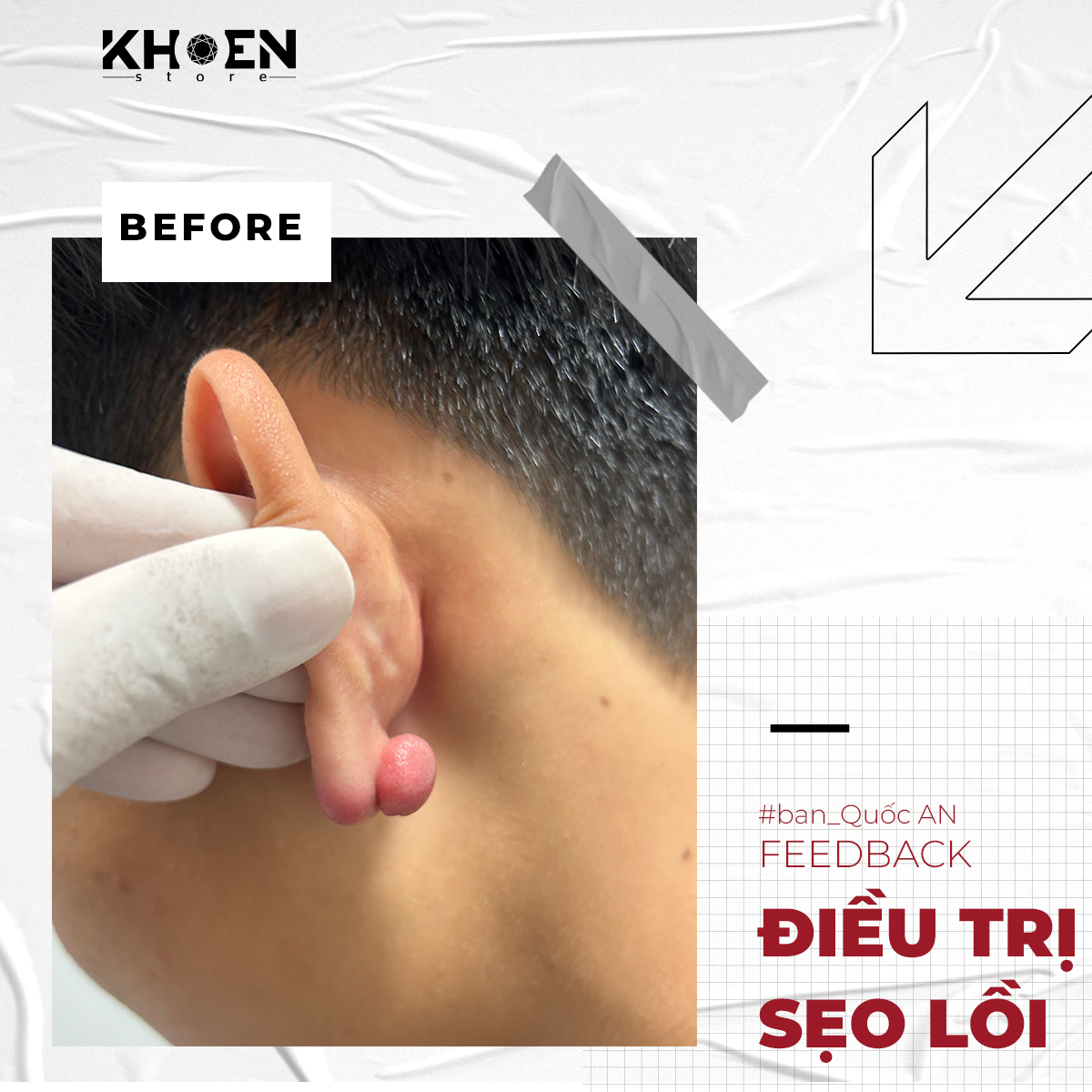 Trước 2 tuần điều trị sẹo lồi của bạn Quốc An